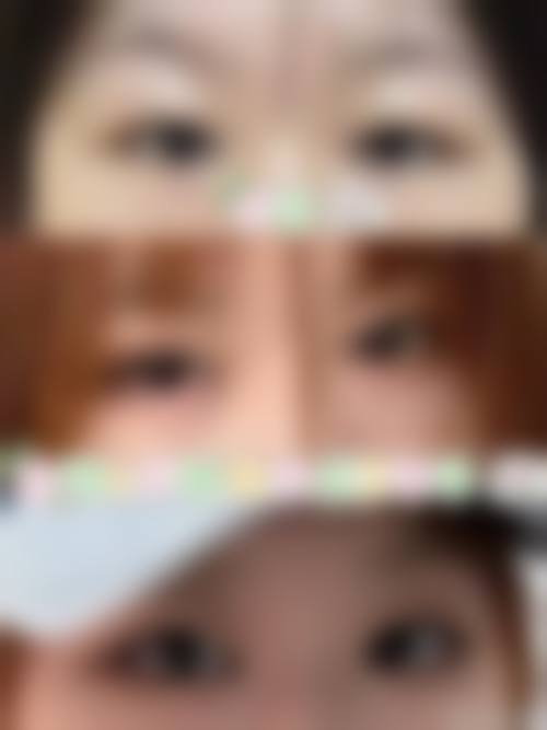 先搞懂两种手术基础，才能明白“不拆线埋线双眼皮改全切”的核心逻辑