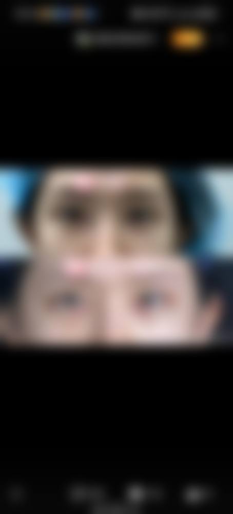 “未拆线埋线双眼皮做全切”的适用场景：这些情况可以放心保留埋线