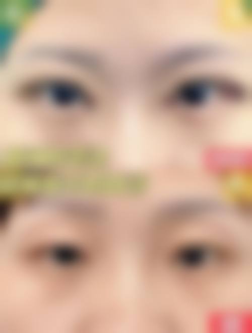 “之前做了埋线双眼皮,线没有抽出直接做了全切”：优缺点全解析