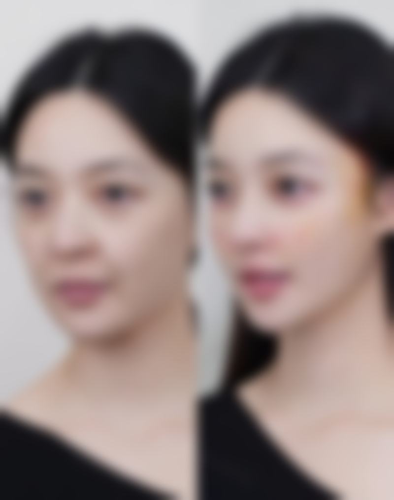 自体隆鼻的危害