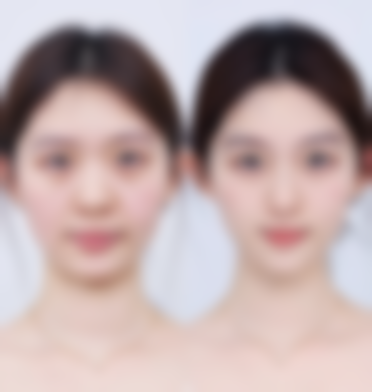 自体隆鼻有副作用吗？2026感染/组织吸收风险解答+3大防范重点看这篇