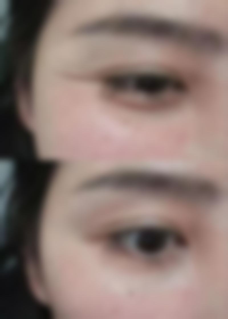 按摩、激光、手术去眼袋常见并发症或后遗问题，在临床中如何理解其发生概率？