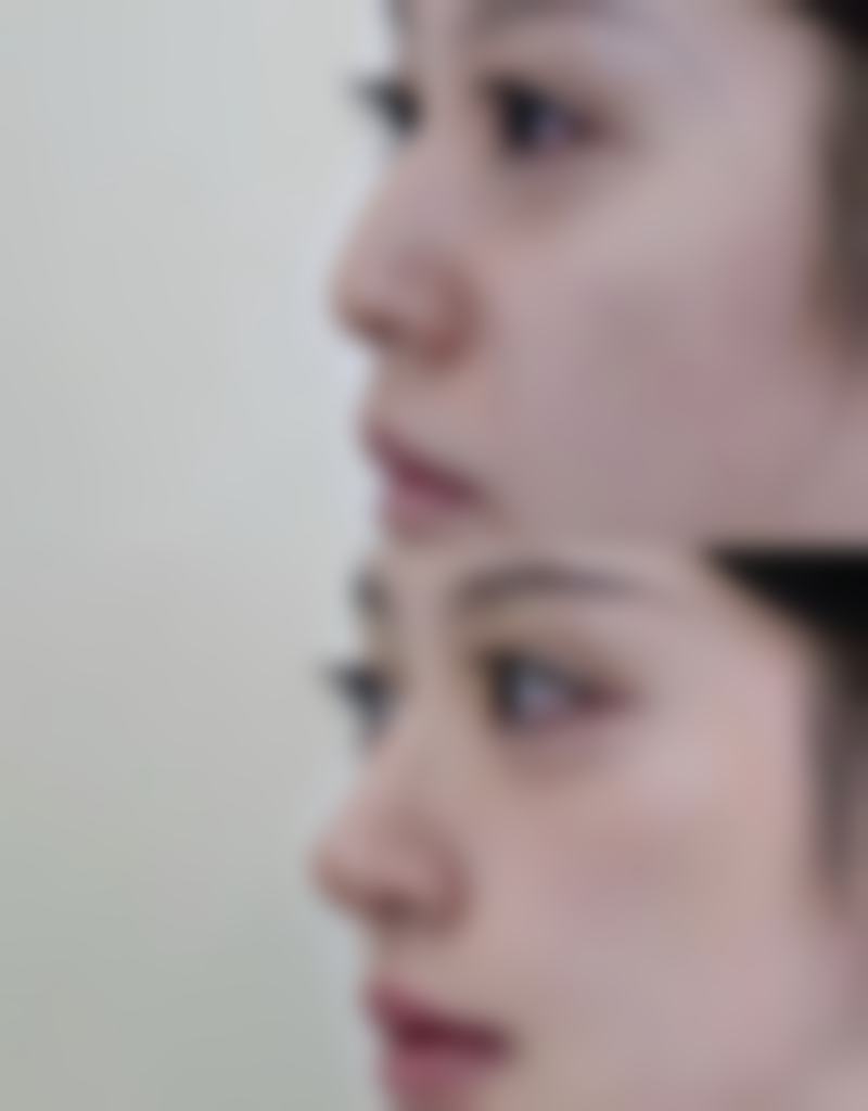 自体隆鼻价格区间及费用差异来源