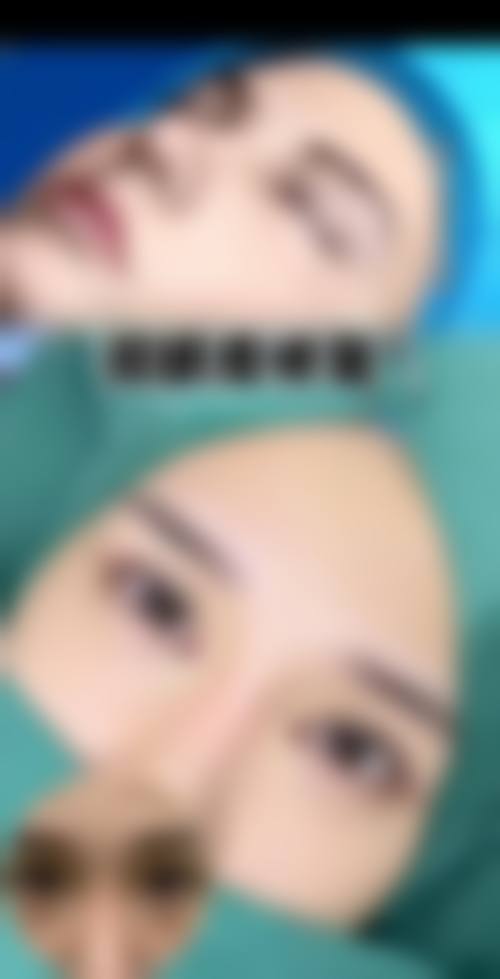 全切双眼皮多久可以进行第二次修复？