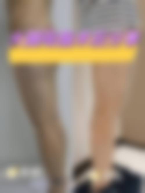 全身抽脂术后真实实例：控制好这些就不会反弹！