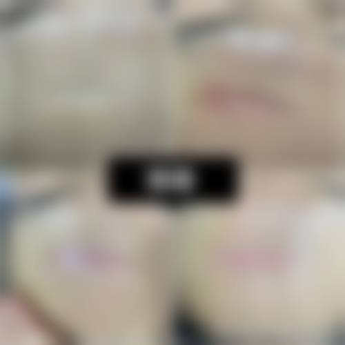 如何判断自己是否适合进行全切双眼皮眼角留疤修复？