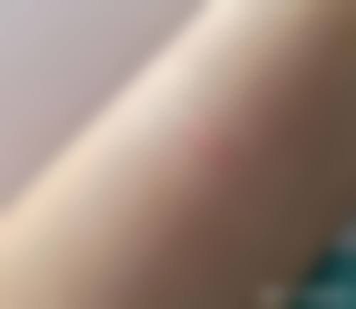 如何为硅酮凝胶、激光治疗和微晶磨皮术设定一个合理且可验证的成效目标