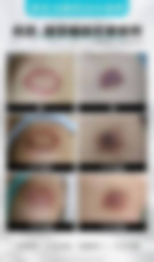 常见硅酮凝胶、激光治疗和微晶磨皮术“成效不明显”的真实原因有哪些