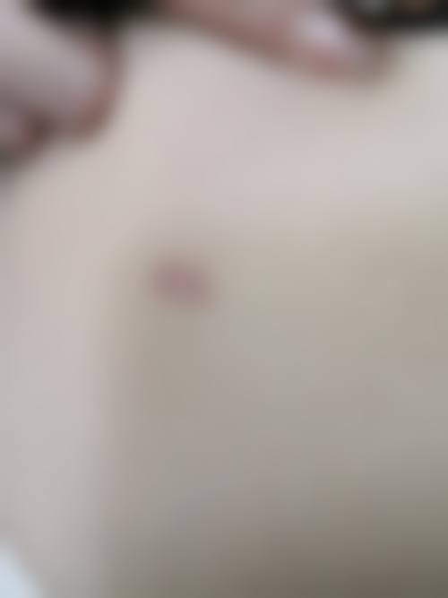 打耳洞疤痕疙瘩治疗常见并发症或后遗问题，在临床中如何理解其发生概率？