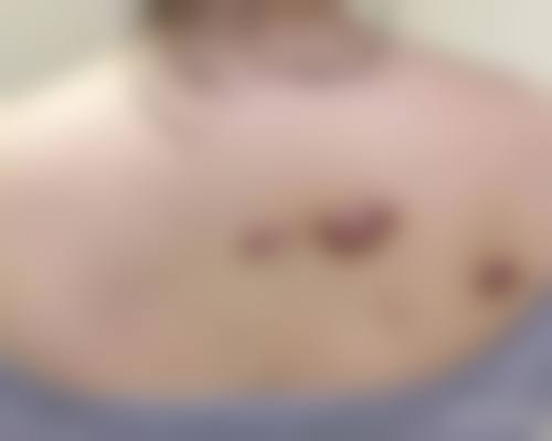 打耳洞疤痕疙瘩治疗的常见认知偏差与误解