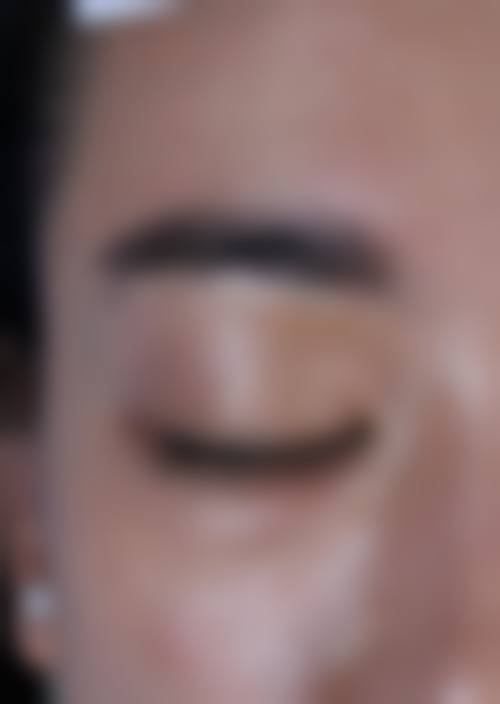 七、耳洞疤痕疙瘩治疗的费用为何差异明显？价格区间如何形成？