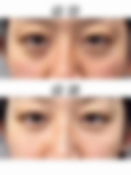 怎么判断我是否适合手术消除眼袋项目？