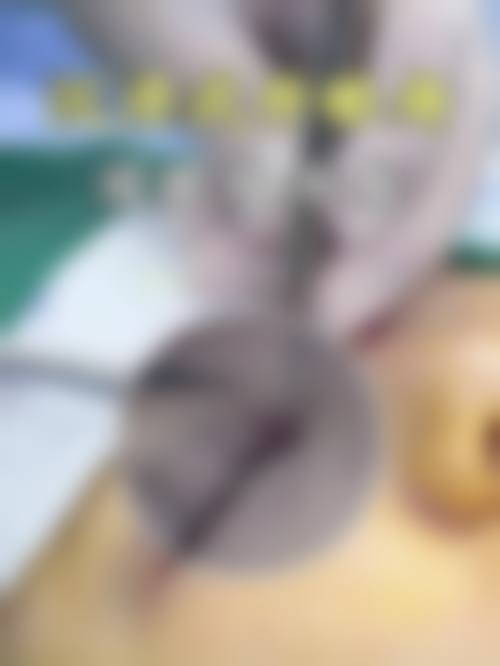 不同方案下哭成三眼皮修复双眼皮维持时间的常见区间