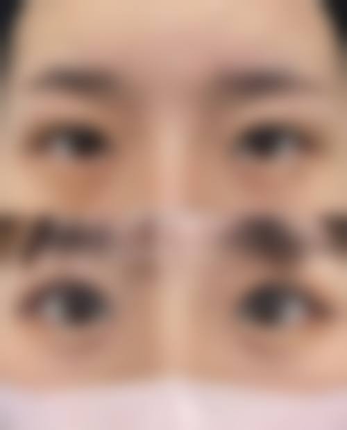 哭成三眼皮怎么恢复双眼皮？3个急救妙招+2种手术方案，7天告别多层眼皮烦恼！