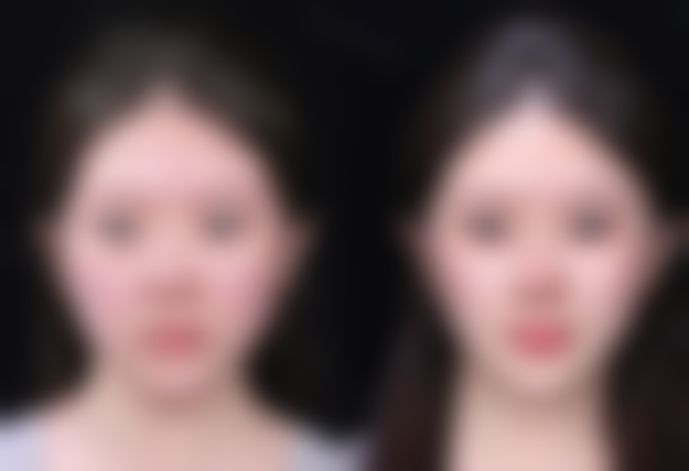 全切双眼皮眼角疤痕有哪些淡化技巧？