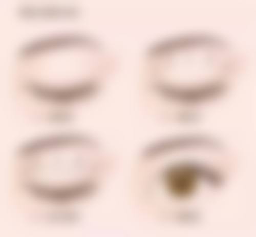 割双眼皮常见并发症或后遗问题，在临床中如何理解其发生概率？