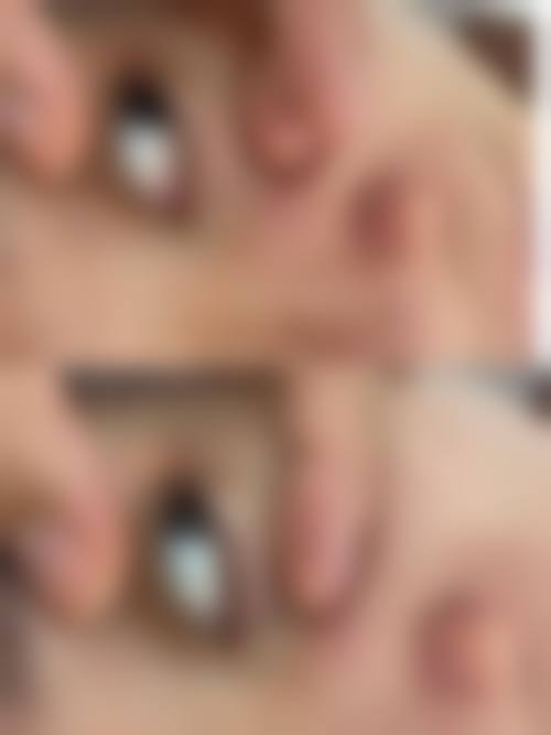 割双眼皮治疗或手术成效通常能维持多久？常见变化路径