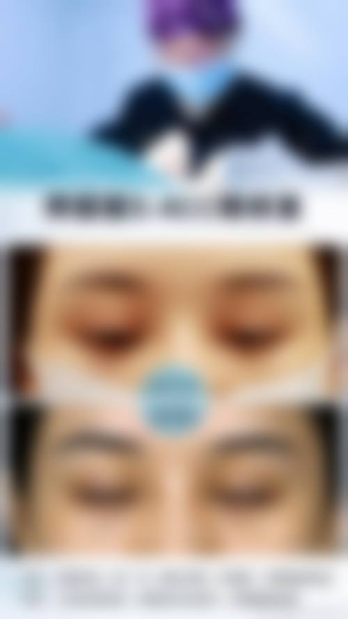 割双眼皮不适宜人群的常见认知偏差与误解