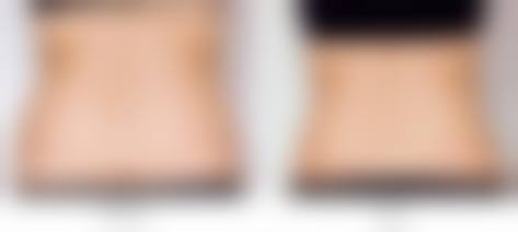 在决定是否选择全身吸脂减肥前,普通用户更容易忽略的关键评估点