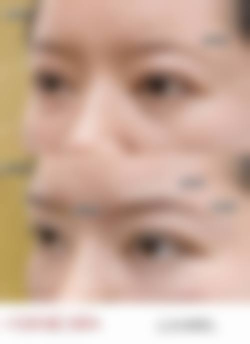 Park 法双眼皮可以去皮吗