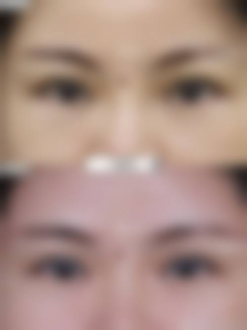 Park 法双眼皮是埋线吗