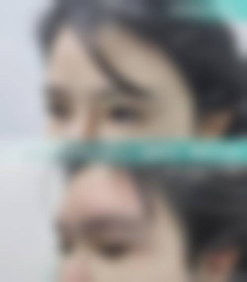 Park法双眼皮适合哪种？适合追求自然持久效果、眼部基础好且惧怕手术恢复慢的人群！形态稳定，重肿泡眼需联合术式