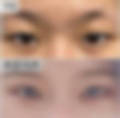 预防眼袋按摩手法的收费价格情况