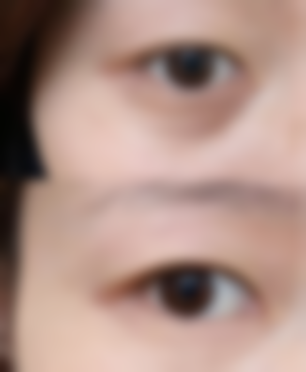 孕妇割双眼皮对自身和胎儿有什么危害？