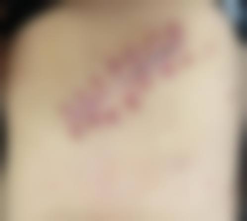 手术缝针疤痕怎么消除？药物涂抹+激光治疗+精心护理，三管齐下淡化效果真超棒！ 