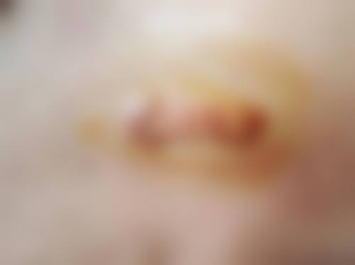 八、手术缝针疤痕消除的成效稳定性取决于哪些因素？