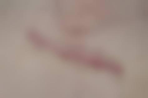 三、从医学角度看，手术缝针疤痕消除的核心目的是什么？