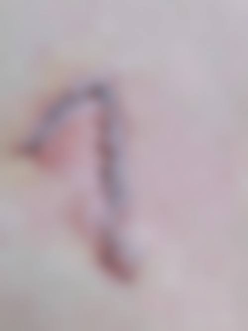 二、手术缝针疤痕消除通常在什么阶段被纳入医疗选择范围？