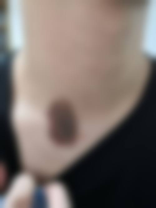 深度烫伤疤痕修复有哪些方法?成效和价格如何?