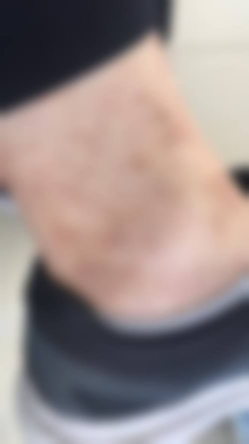 如何选择治疗烫伤疤痕的医院和医生?