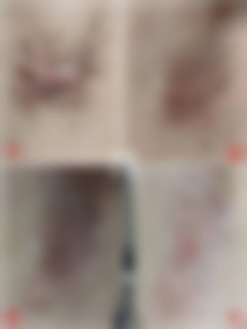 五、在实际操作中，手术缝针疤痕消除更适合哪些人？