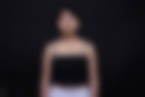 {取假体隆胸有后遗症吗？有！包膜挛缩、乳房变形、感染等7大后遗症务必警惕！ 