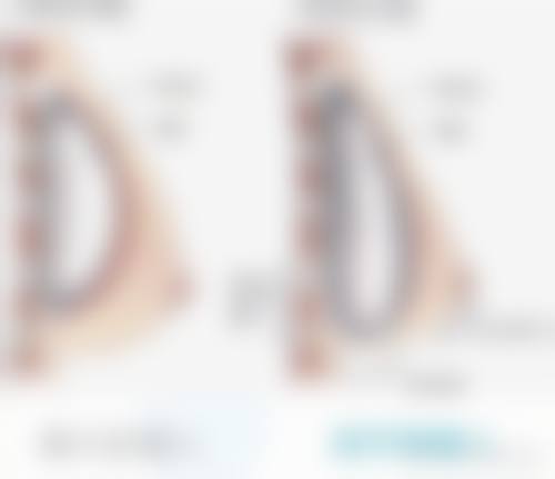 取假体隆胸有后遗症吗?有!包膜挛缩、乳房变形、感染等情况需警惕!真实修复过程与不适时间线