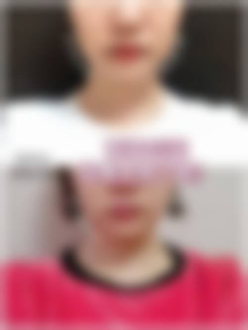 瘦脸针是什么？通常在什么医学背景下被选择？