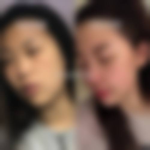 在决定是否选择瘦脸针前，普通用户更容易忽略的关键评估点及医院医生推荐