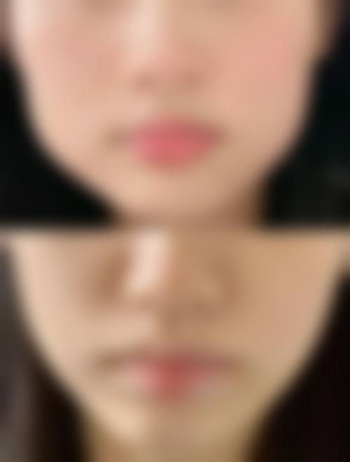 瘦脸针常见并发症或后遗问题，在临床中如何理解其发生概率？