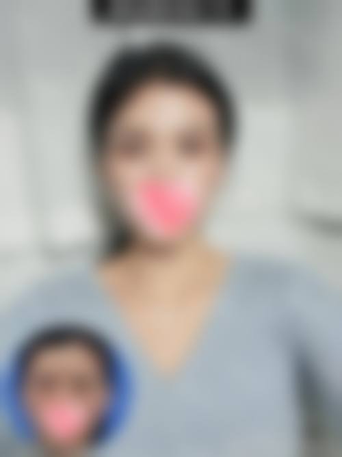 眼部拨筋去眼袋有用吗？成效究竟如何验证？