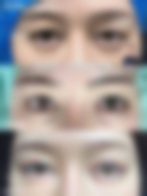 割双眼皮和贴双眼皮哪些人群适合，哪些情况不建议选择？