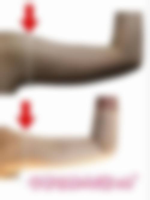 手臂抽脂是什么？通常在什么医学背景下被选择？