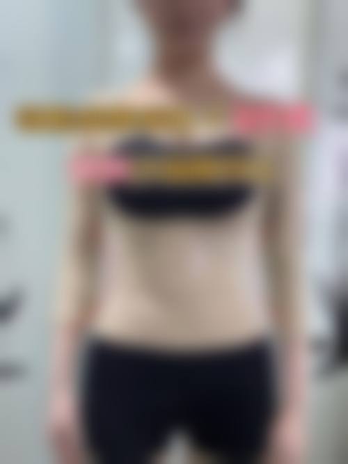 水动力吸脂、共振吸脂和负压吸脂的成效能维持多久?