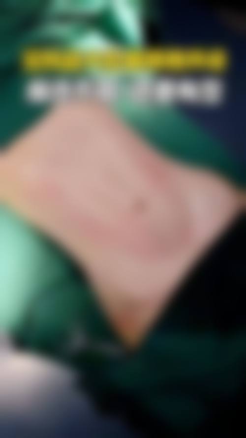 哪些人群在评估中更可能被建议考虑手臂抽脂？