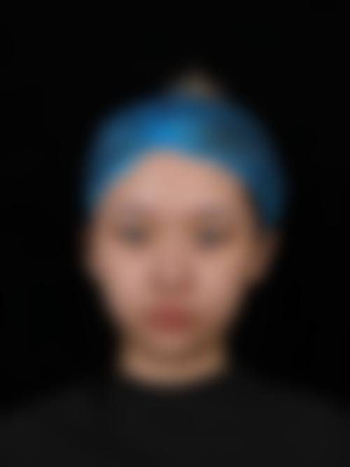 怎么判断我是否适合双眼皮手术？