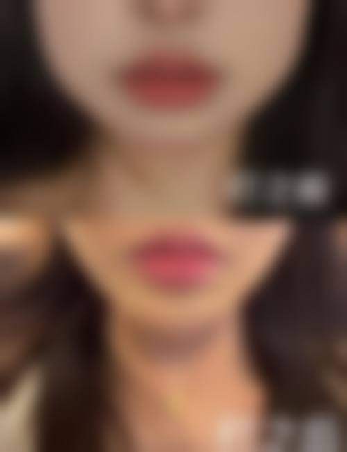 打完瘦脸针多久能平躺睡觉的影响因素