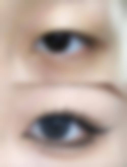 九、围绕卢尚兵修复双眼皮，临床中更常见的并发问题有哪些？