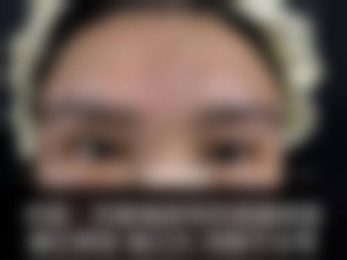 七、卢尚兵修复双眼皮的费用为何差异明显？价格区间如何形成？