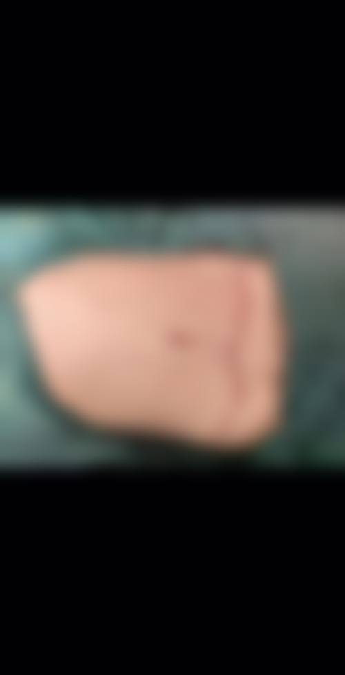 腰腹吸脂是吸哪些位置？主要吸上腹部、下腹部、侧腰部，精准塑形效果惊人！术后多久掉围度？价格大概多少告诉你！ 